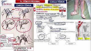 Fracturas Fémur  Ortopedia y Traumatología Clases Qx Medic  14 [upl. by Mannes155]