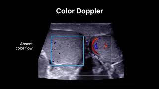 Diagnosing testicular torsion [upl. by Siryt296]