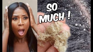 REACTING TO EXTREME DANDRUFF SCRATCHING  Home Remedies For Dandruff Removal [upl. by Tori860]