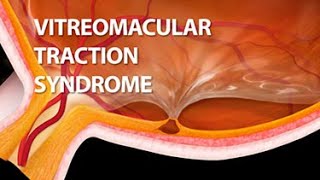 Vitreomacular Traction Syndrome [upl. by Eedrahc630]