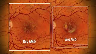 The 5 Causes of Macular Degeneration  Dr Alan Mendelsohn [upl. by Chader]