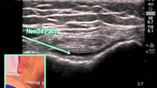 How to Ultrasound Guided Knee Injection Scanning Technique [upl. by Merry]