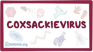 Coxsackievirus  an Osmosis Preview [upl. by Franck943]