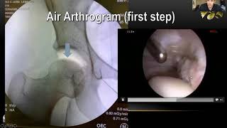 InternalBrace™ MCL Augmentation Repair [upl. by Hadley]