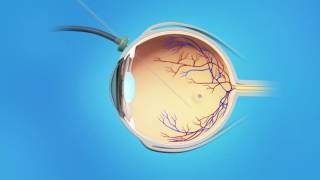 Macular Hole Vitrectomy Surgery [upl. by Grand]