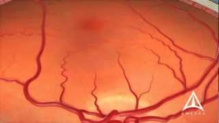 Dry Macular Degeneration [upl. by Airlia]