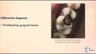 Chronic Hyperplastic Pulpitis  Pulp Poly  Oral Medicine [upl. by Ymmor701]