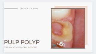 PULP POLYP  CHRONIC HYPERPLASTIC PULPITIS [upl. by Parshall352]