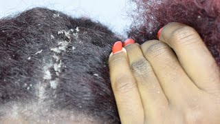 ITCHY DRY SCALP  SCRATCHING DANDRUFF [upl. by Jordison]