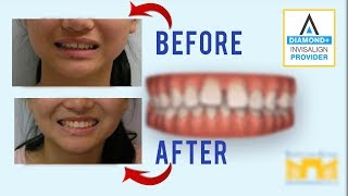 Invisalign Before and After Gap in Teeth [upl. by Aztilay]