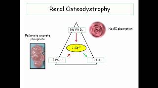 12DaysinMarch Renal Osteodystrophy for the USMLE Step One [upl. by Alet]