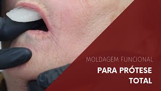 Moldagem Funcional para Prótese Total [upl. by Aneeuqahs]