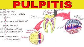 Pulpitis  Pathophysiology Causes amp Types [upl. by Retrac]