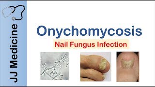 Onychomycosis  Nail Infection  Signs Symptoms Treatment [upl. by Shornick]