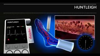 Portal Vein Doppler  Normal Monophasic Flow [upl. by Staford]