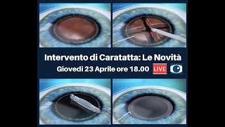 Intervento di Cataratta Le Novità [upl. by Jessie347]