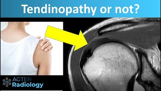 Tendinopathy Tendinosis of Rotator Cuff Tendons on MRI [upl. by Zina351]