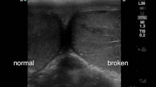 Testicular Fracture Ultrasound Findings [upl. by Cullin]