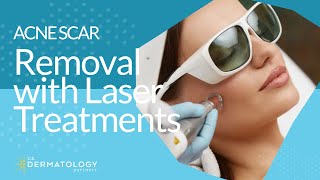 Acne Scar Removal with Laser Treatments [upl. by Noside46]