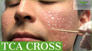 Acne Scar Removal with TCA Cross 80  Los Angeles  Dr Ben Behnam [upl. by Asirret]