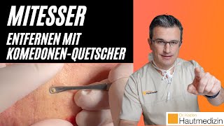 Mitesser entfernen mit Komedonenquetscher Wie geht das  Dr Kasten Hautmedizin in Mainz mitesser [upl. by Megen]