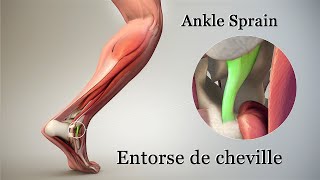 Entorse de cheville en Urgence Ankle Sprain [upl. by Conti]