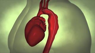 Mayo Clinic – Thoracic Aortic Aneurysm [upl. by Alberto108]