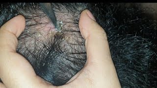 best patch of dandruff scab found so far  satisfying  watch till end  scab pick using knife asmr [upl. by Ziom]