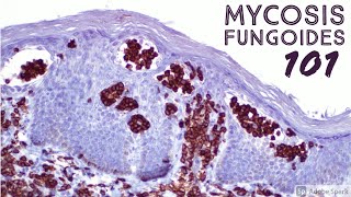 4 Staging amp Pathogenesis of Mycosis Fungoides Sezary Syndrome [upl. by Zoilla]