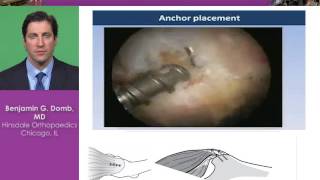 Gluteus Medius Tears Techniques and Indications [upl. by Narik334]