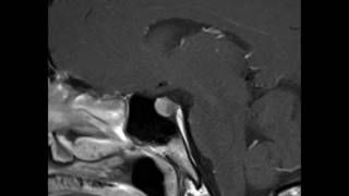 Pituitary Microadenoma [upl. by Sehguh505]