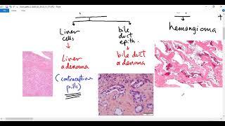 Systemic pathology 76  Liver tumors Dr Sameh Ghazy [upl. by Steward844]