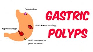 Gastric Stomach Polyps [upl. by Inverson]