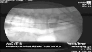 Interventional Radiology Esophageal Stent [upl. by Oflodor]