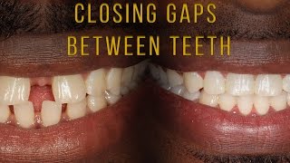 Closing Gaps Between Teeth With Braces [upl. by Kania]