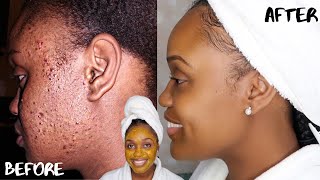 HOW TO GET RID OF ACNE SCARS AND DARK MARKS FAST  DIY TURMERIC HONEY LEMON AND ALOE FACE MASK [upl. by Eilraep116]