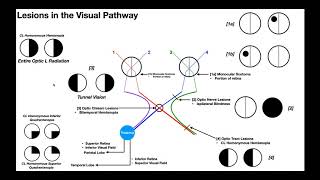 Lesions to the Visual Pathway EXPLAINED [upl. by Bocoj943]