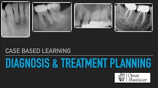 Case Based Learning Diagnosis and Treatment Planning in Endodontics [upl. by Aivatnahs]