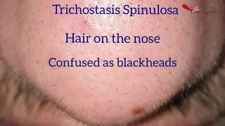 Hair removal on the nose by Laser  Trichostasis Spinulosa [upl. by Boylan205]