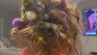 6YearOld Gets 150 Bunchems Velcro Balls Stuck in Her Hair [upl. by Blinnie356]