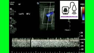 Monophasic Doppler Waveform [upl. by Auqinaj]