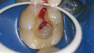 PULPITIS ENDODONTIC TREATMENT ROOT CANAL Intrapulpal anestesia HOT TOOTH [upl. by Salazar]