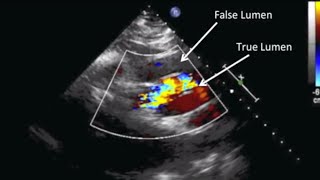 Abdominal Aortic Aneurysm AAA Ultrasound [upl. by Oilerua]