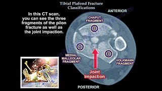 Tibial Plafond Fracture Classification  Everything You Need To Know  Dr Nabil Ebraheim [upl. by Eimyaj]