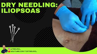 Dry Needling Iliopsoas [upl. by Candice596]