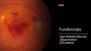 How Macular Degeneration Causes Vision Loss  WebMD [upl. by Johanan]