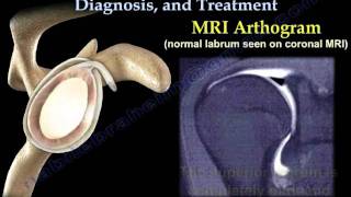 Meniscus Tears  Everything you need to know [upl. by Epoh]