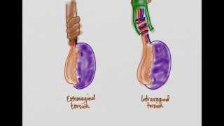 Testicular Torsion [upl. by Hymie]