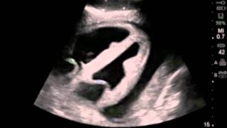 How To Ultrasound Guided Pericardiocentesis Procedure 3D Video [upl. by Lyrehc441]