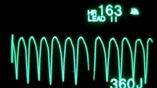 01  Normal Lung Sounds  Vesicular breath sounds [upl. by Ocsisnarf949]